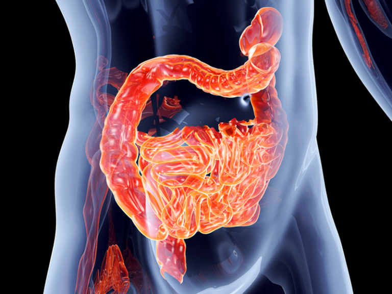 Ulcerózna kolitída | Príznaky vredového zápalu hrubého čreva