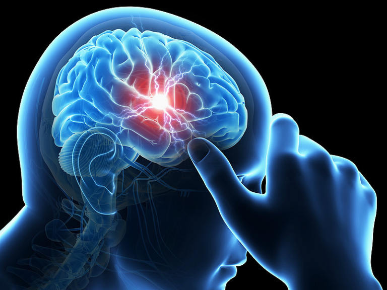 Príznaky mozgovej porážky | Spoznajme skryté symptómy